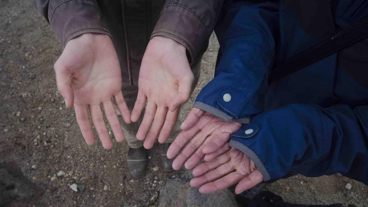 Two sets of hands held out to the camera show signs of swelling, a symptom of high altitude sickness